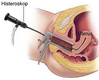 Histeroskopi Nedir?