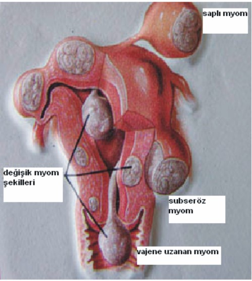Myomlarda Ve Rahim Ameliyatlarında Laparoskopi