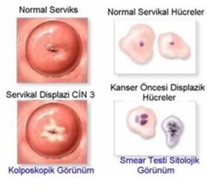 Genital Siğiller