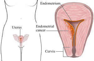 Rahim  (ENDOMETRİUM) Kanseri