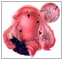 Endometriozis