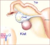 Yumurtalık Kistlerinde Laparoskopi