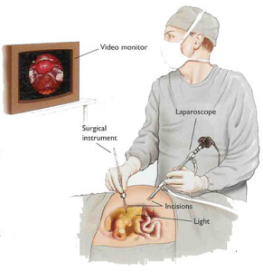 laparoscopy