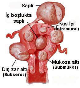 Myomlar Ve Kısırlık