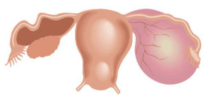 ovarian-cyst2[1]