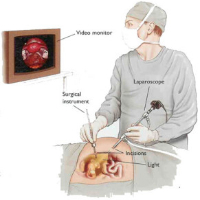 Laparoskopi&Histeroskopi