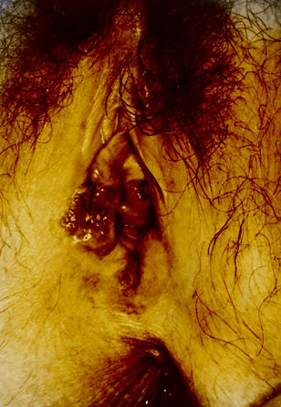 Dış Genital Organ (Vulva) Kanseri